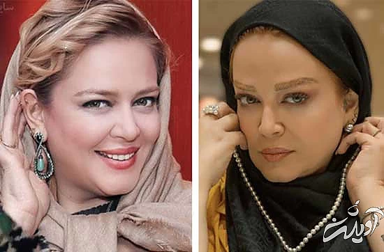 جراحی افتادگی پلک؛ جراحی افتادگی پلک؛